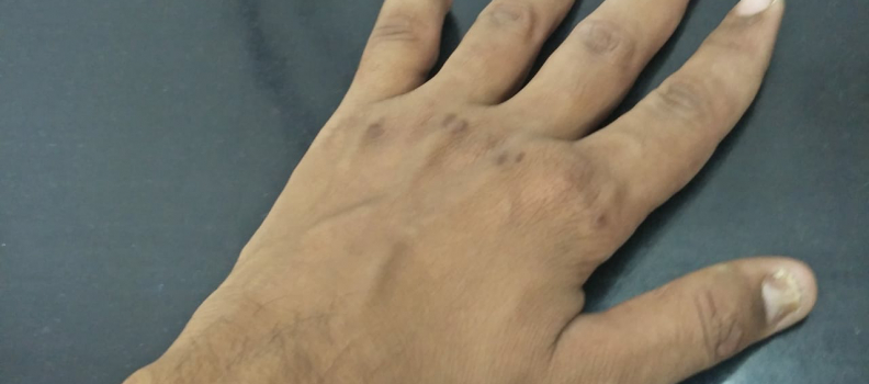 Crush finger with multiple bone fractured in hand Repaired